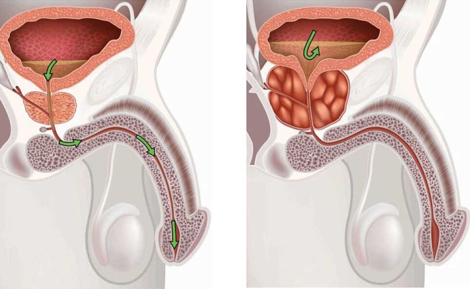 Infiammazione della ghiandola prostatica