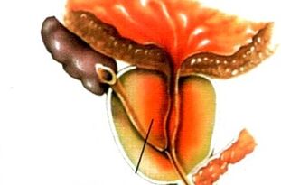 Cos'è la prostatite negli uomini