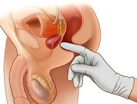 Massaggio prostatico per il trattamento della prostatite negli uomini