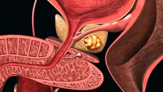 Depositi di calcoli nella prostata con prostatite calcolosa