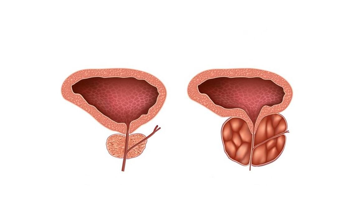sintomi di prostatite negli uomini