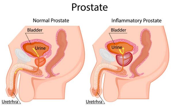 prostata sana e infiammata