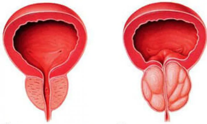 Prostata normale (a sinistra) e prostatite cronica infiammata (a destra)