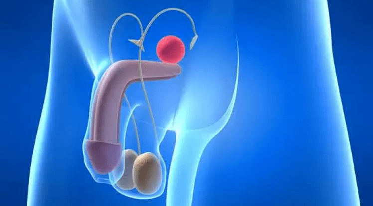 La prostatite è un'infiammazione della ghiandola prostatica negli uomini, che richiede un trattamento complesso